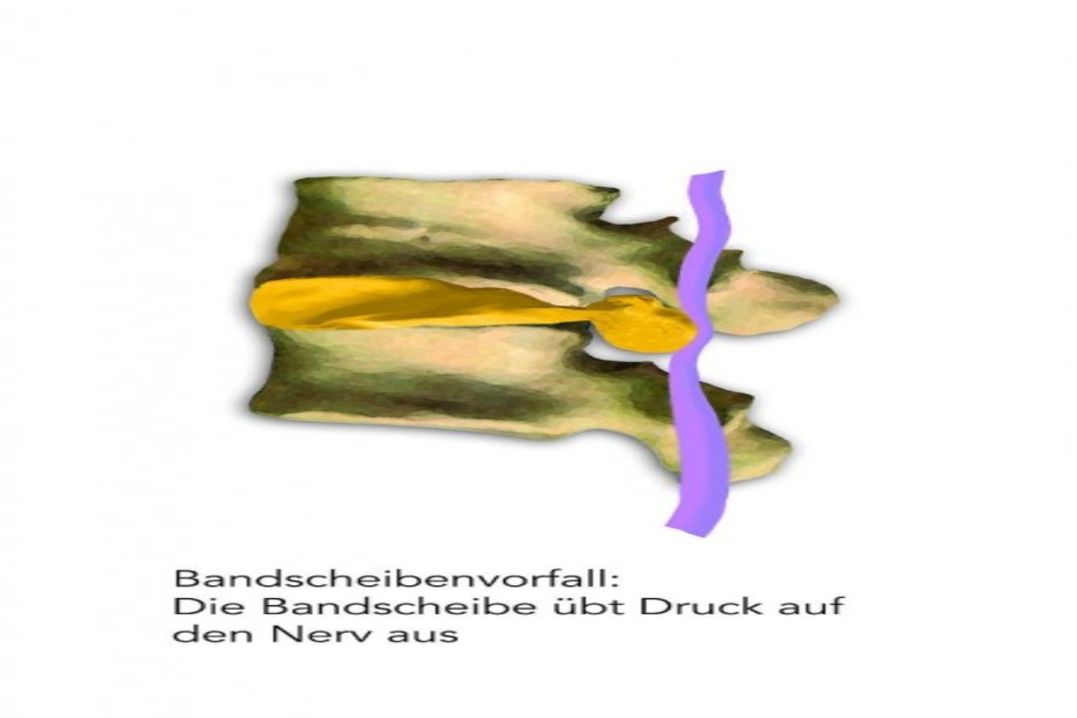 Bandscheibenvorfall oder Bandscheibenvorwölbung